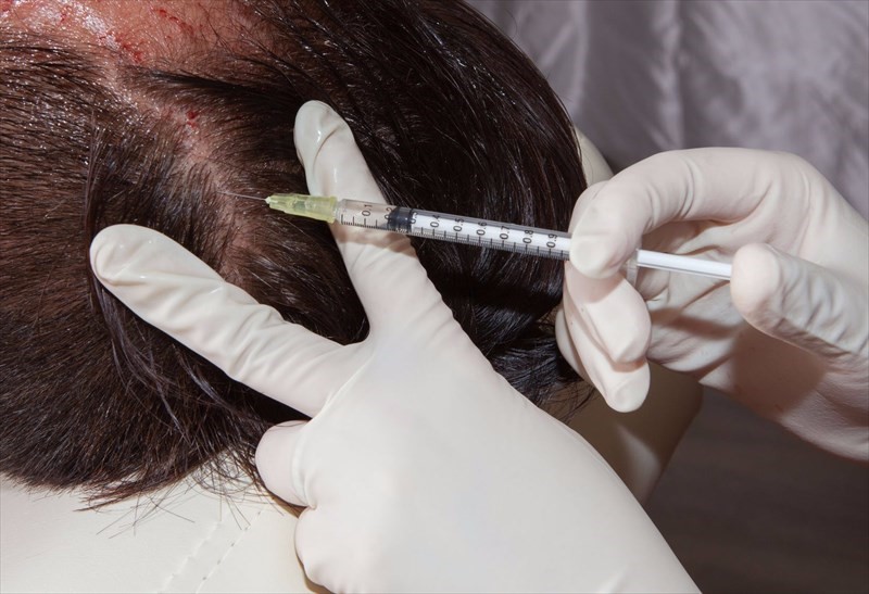 Alopecia Areata Treatment