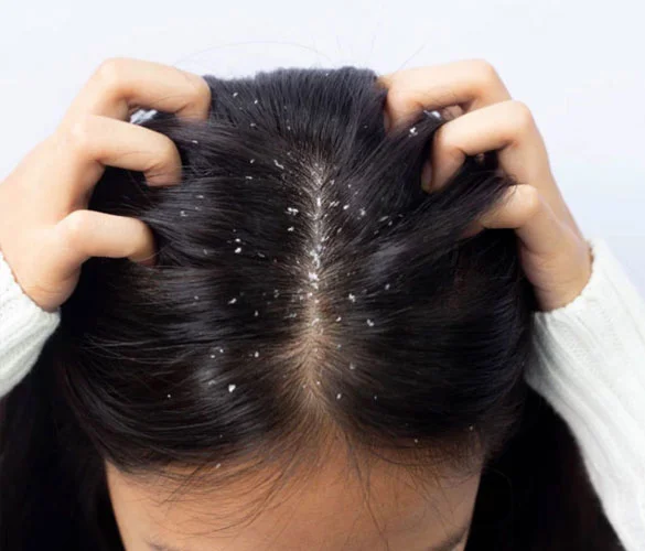 Anti-Dandruff Treatment