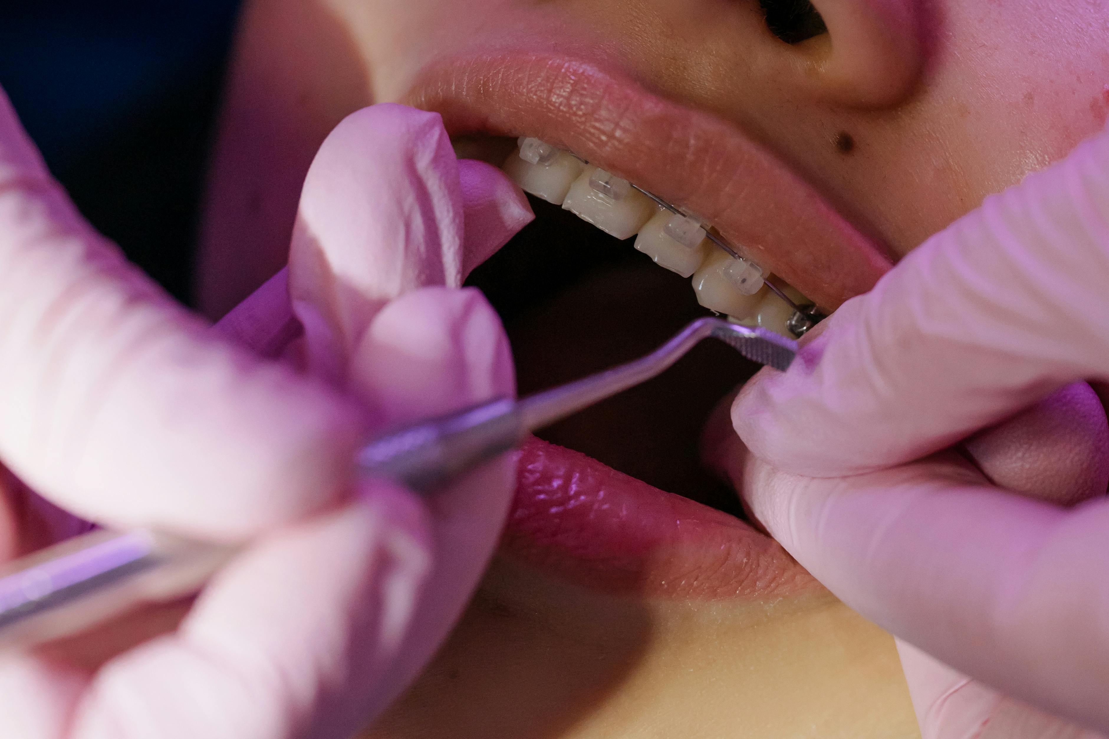 Metal / Ceramic Braces