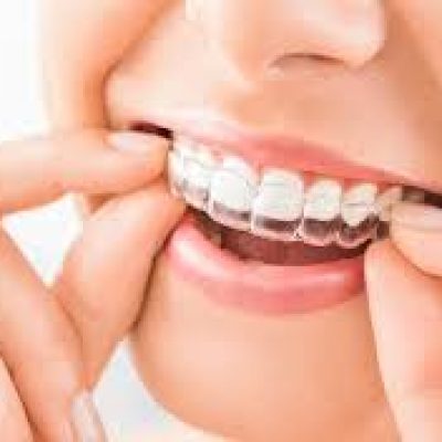 Invisible Braces