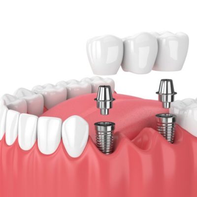 Cosmetic Gum Treatment