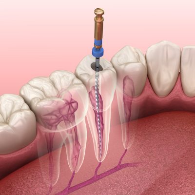 Dental Implants